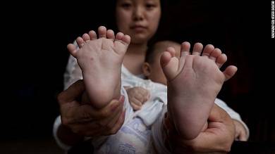 Αγοράκι στην Κίνα γεννήθηκε με 31 δάχτυλα 