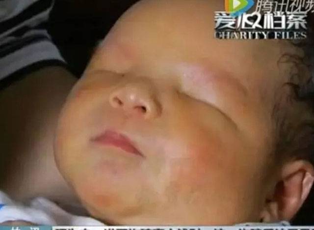 Σπάνιο φαινόμενο-Μωρό στην Κίνα γεννήθηκε χωρίς μάτια