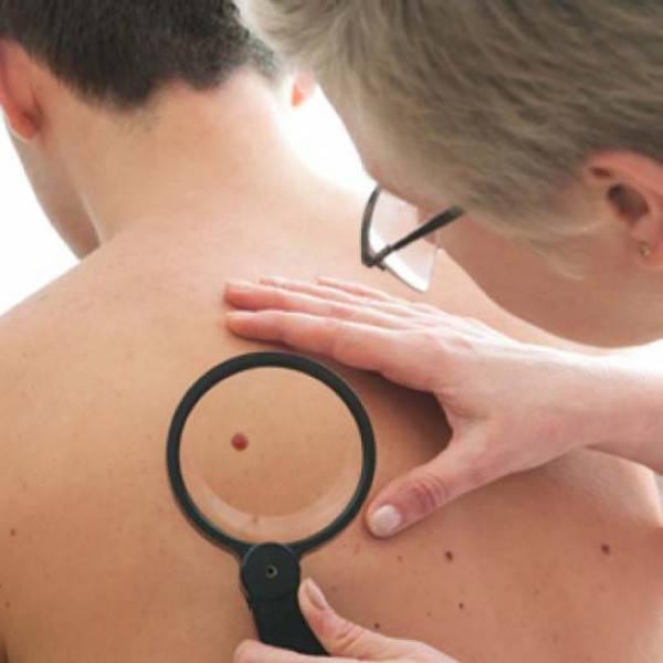 Καρκίνος του δέρματος: Σημάδια και συμπτώματα