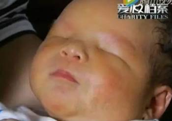 Σπάνιο φαινόμενο-Μωρό στην Κίνα γεννήθηκε χωρίς μάτια